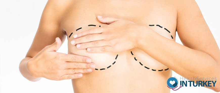 Breast Augmentation